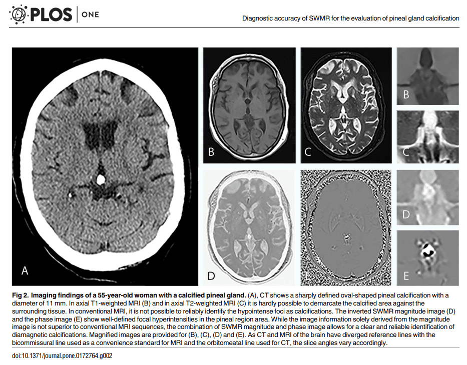 Brain scan of the pineal gland calcified